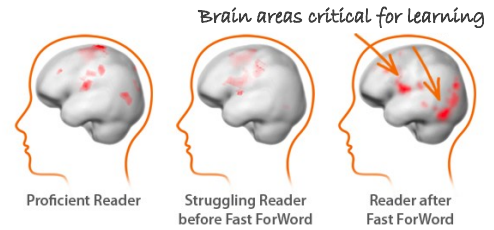 Evidence for FFW brain MRI