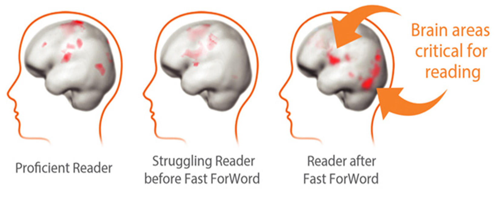 Fast-ForWord-improves-brain-areas-critical-for-reading